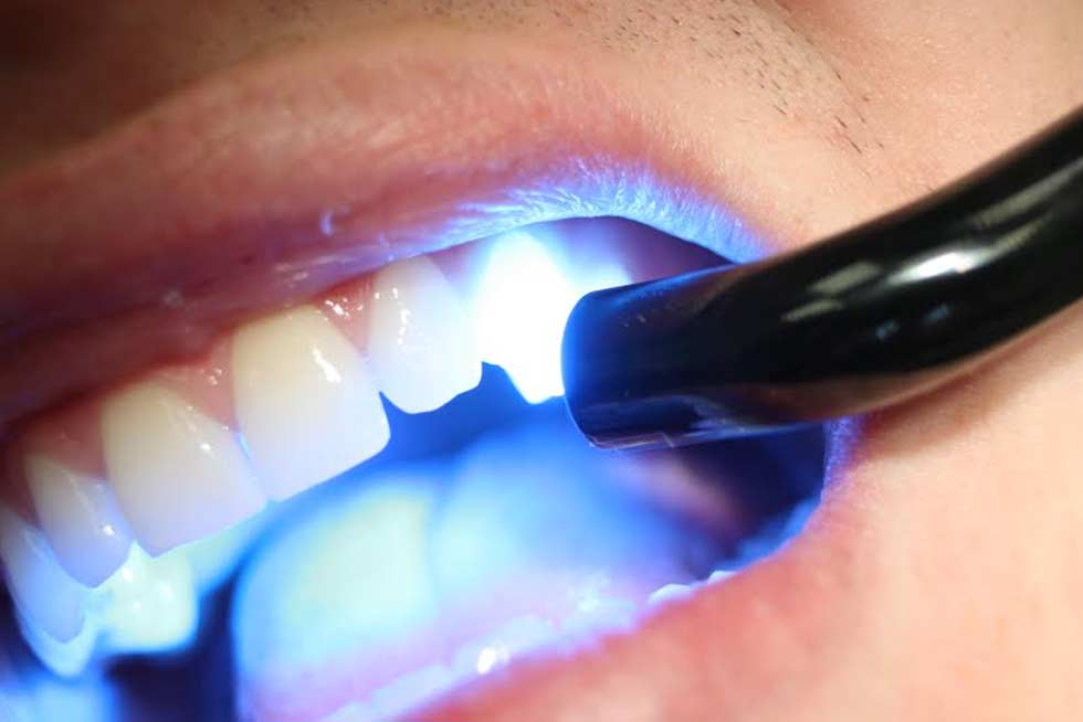 Resinas Dentales